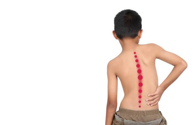 adolescent-idiopathic-scoliosis-all-what-you-need-to-know-about-it صورة المقال
