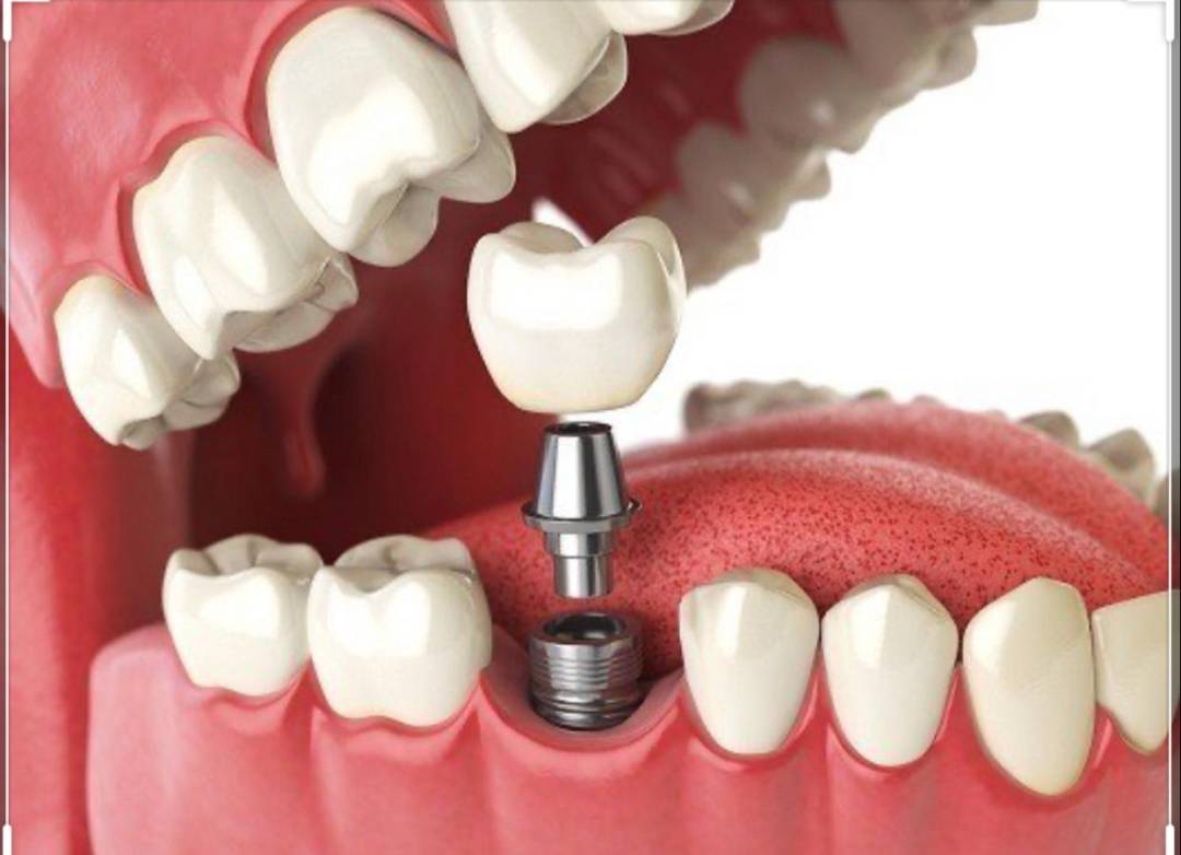 عملية زراعة الأسنان | Top Doctors