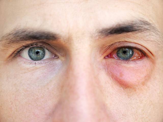 حساسية العين اعراض افضل قطرة