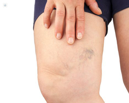 What Is the Difference Between Spider Veins and Varicose Veins?